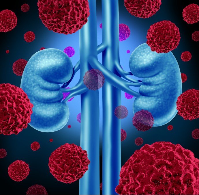 Kidney_cancer