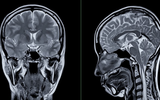 MRI scan of the brain