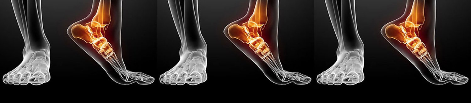 a graphic of a foot x-ray with orange to depict inflammation