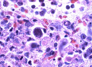 Cytomegalovirus infection