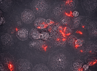 Human immune cells called macrophages that have been infected with tuberculosis bacteria. 