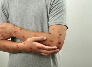Mpox