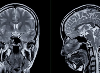 MRI scan of the brain