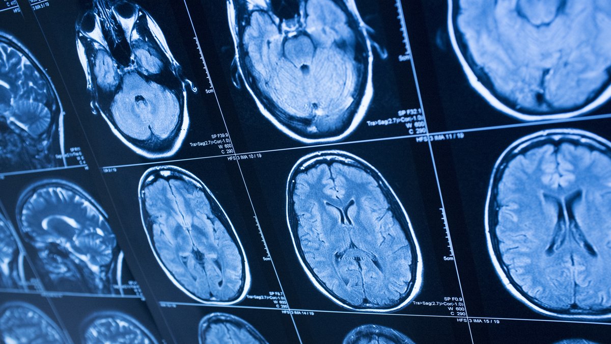 X-Ray of brains
