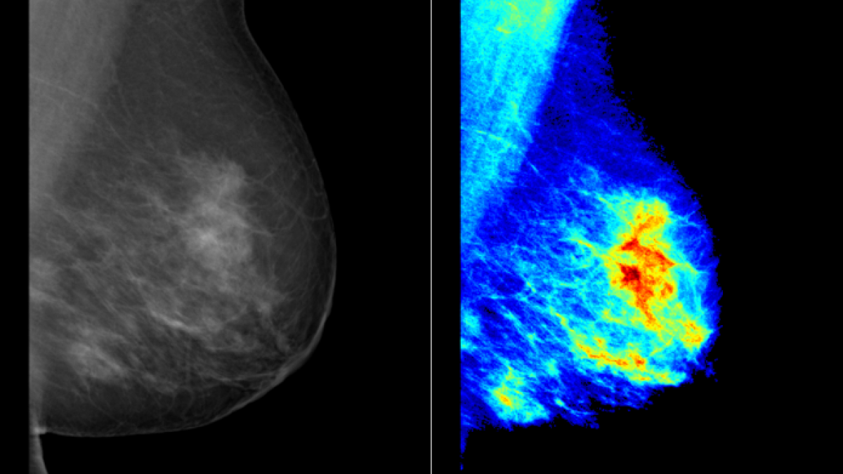 Breast density maps