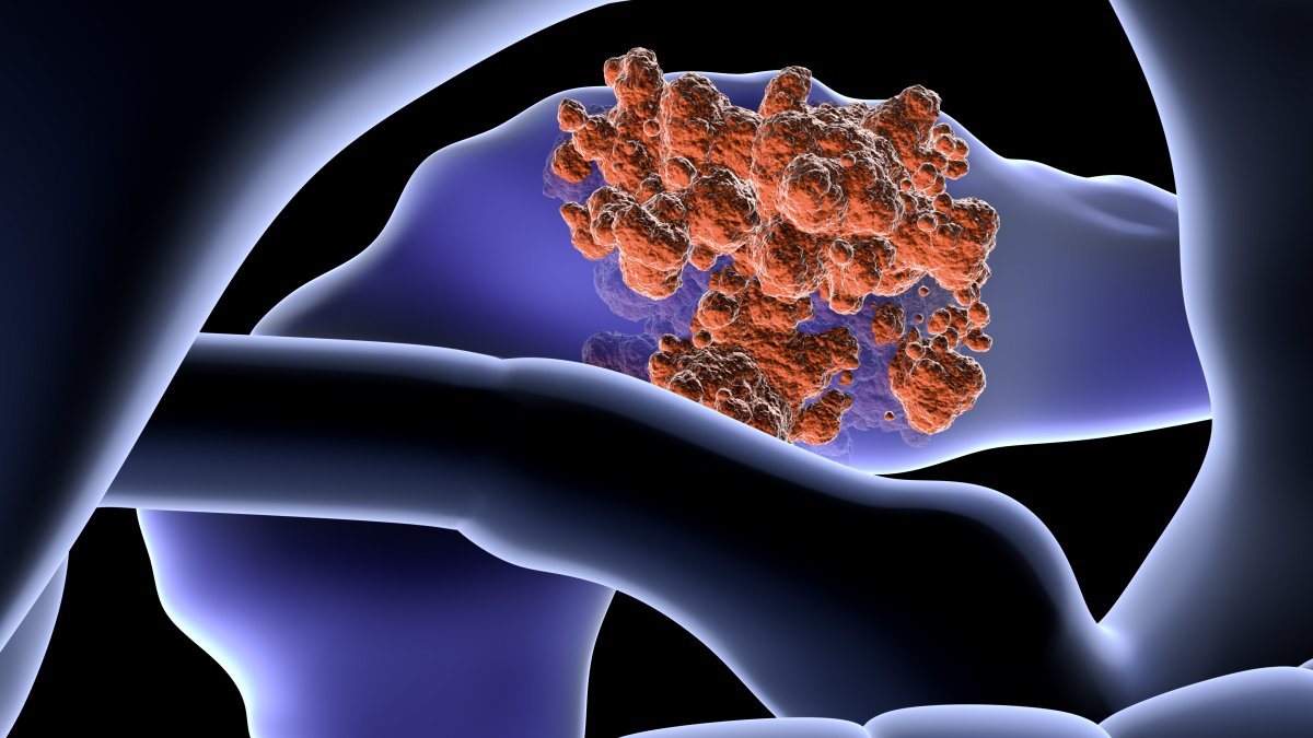 Pancreatic cancer cells