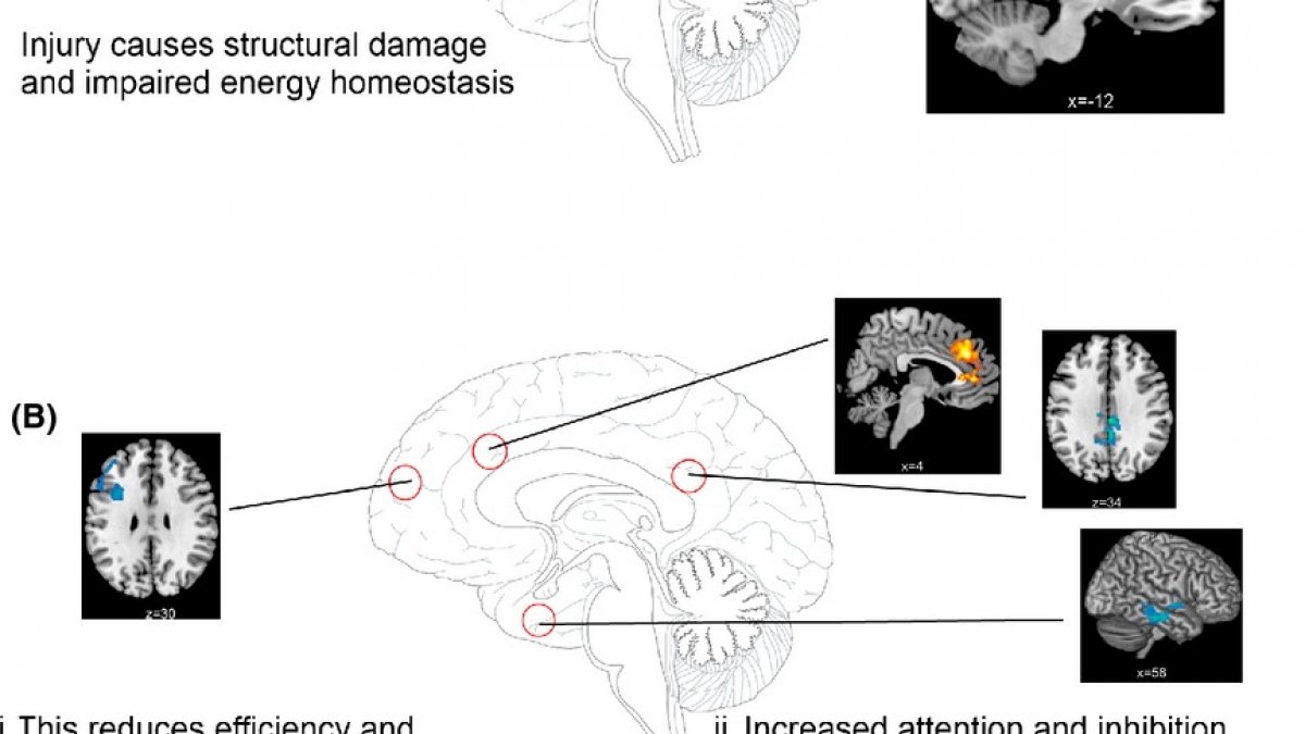 MultiModal Data mTBI