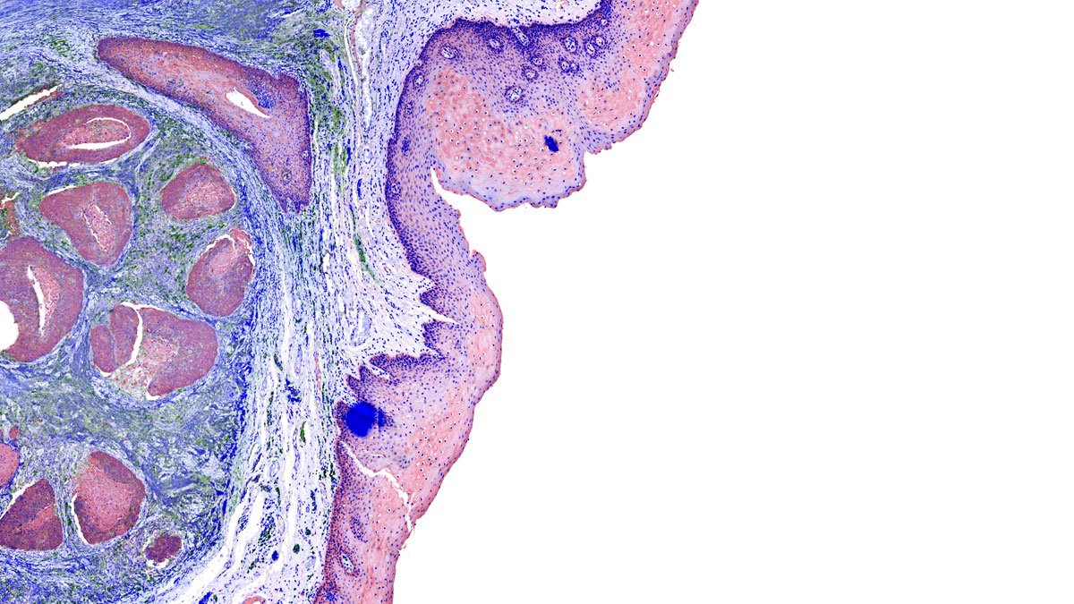 Illustration of cancel cells