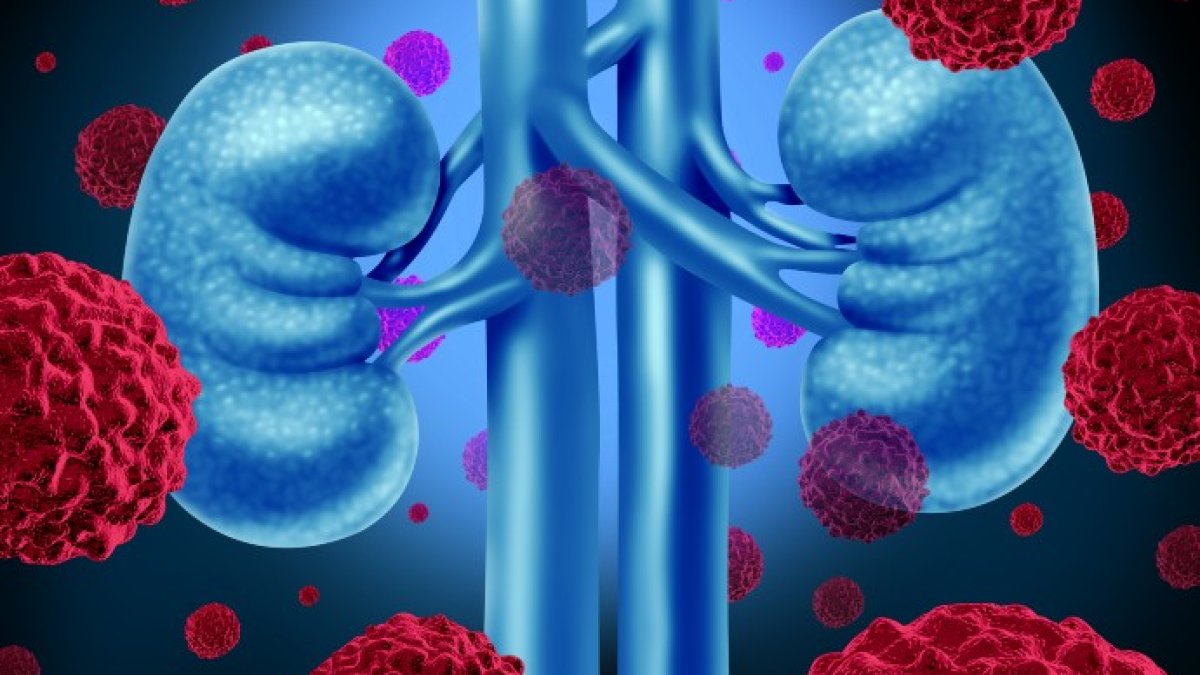 Kidney_cancer