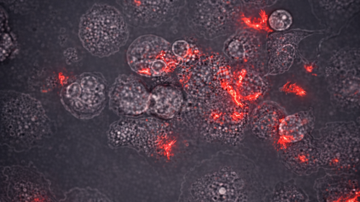 Human immune cells called macrophages that have been infected with tuberculosis bacteria. 