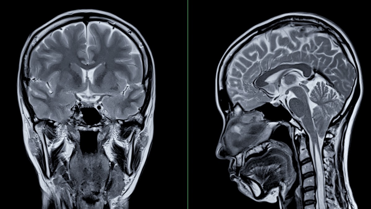 MRI scan of the brain