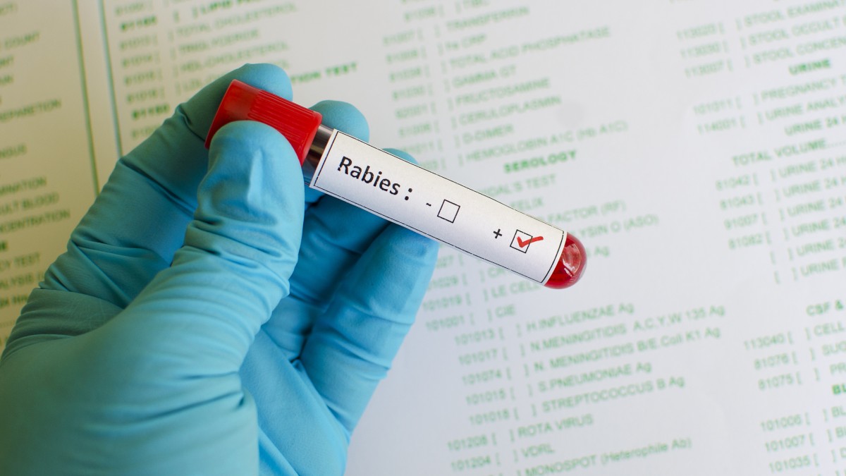 Blood sample with rabies virus positive