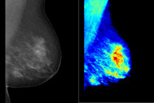 Breast density maps