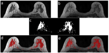 Segmentation MRI
